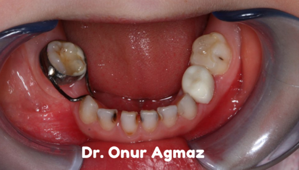 Yer Tutucular: Çocuk Diş Hekimi Tarafından Ebeveynlere Kılavuz