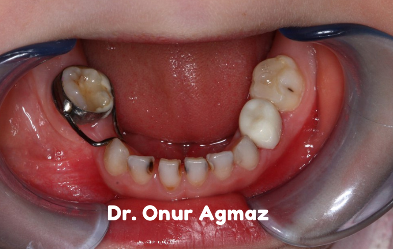 Yer Tutucular: Çocuk Diş Hekimi Tarafından Ebeveynlere Kılavuz